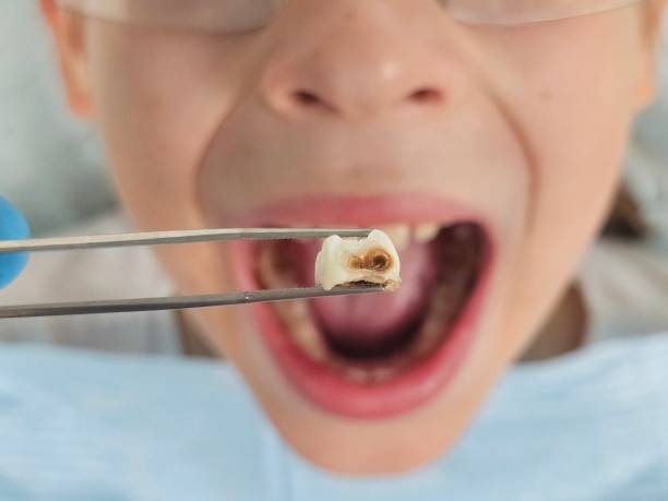 Best Emergency Dental Extractions in Rossmoor, NJ